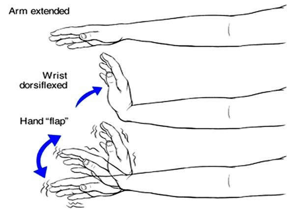 MEDICINA ONLINE Asterixis Flapping Tremor TREMORE ASTERISSI ASTERIXI SEMEIOTICA NEUROLOGIA UREMIA INSUFFICIENZA RENALE EPATICA IPERAMMONIEMIA ENCEFALOPATIA CIRROSI MANI TREMOLIO TIC SPASMI MANO.jpg