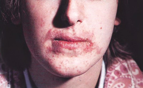 MEDICINA ONLINE DERMATITE ALLERGICA DA CONTATTO CON COSMETICI ROSSETTI CREMA ANTI SCREPOLATURA VISO FACCIA ROSSORE LESIONI DERMA PELLE CUTE DERMATOLOGO ALLERGOLOGO IMMUNOLOGO