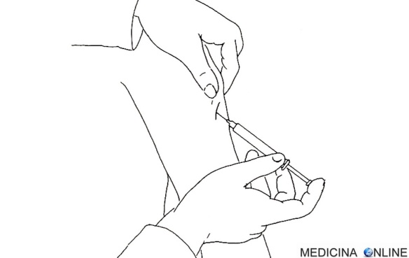 MEDICINA ONLINE IMMUNOTERAPIA SPECIFICA VACCINO IPOSENSIBILIZZAZIONE SPECIFICA INIEZIONE SPALLA SOTTOCUTANEA.jpg