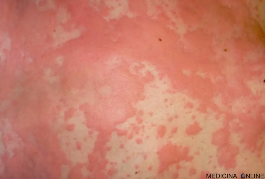 MEDICINA ONLINE ORTICARIA POMFI DERMATOSI HIVES URTICARIA