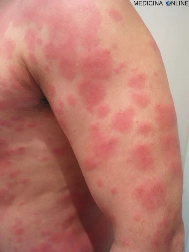 MEDICINA ONLINE ORTICARIA POMFI DERMATOSI HIVES URTICARIA
