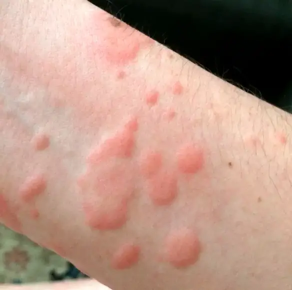 MEDICINA ONLINE ORTICARIA POMFI DERMATOSI HIVES URTICARIA