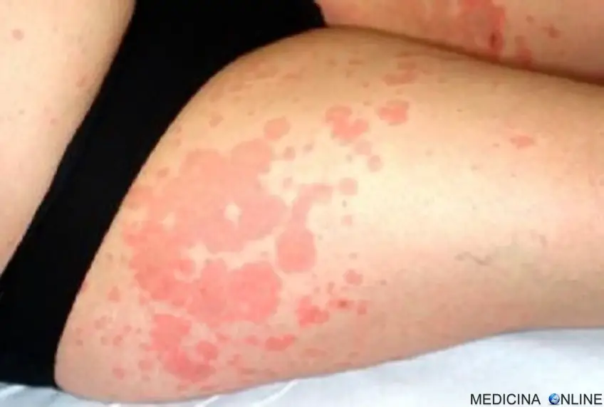 MEDICINA ONLINE ORTICARIA POMFI DERMATOSI HIVES URTICARIA