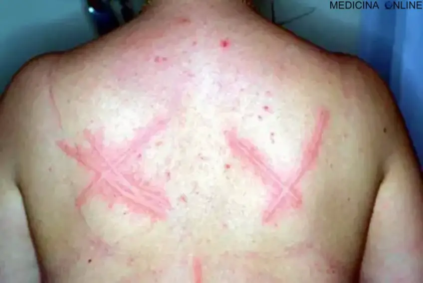 MEDICINA ONLINE ORTICARIA POMFI DERMATOSI HIVES URTICARIA