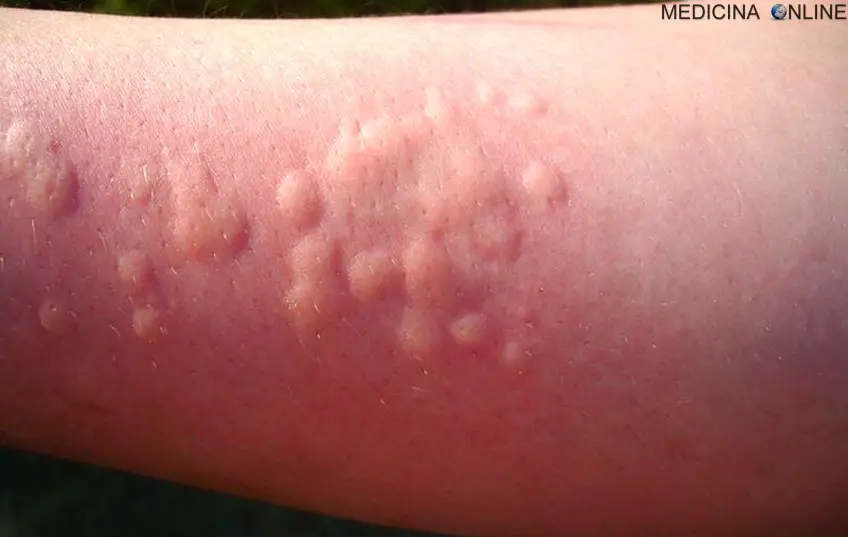 MEDICINA ONLINE ORTICARIA POMFI DERMATOSI HIVES URTICARIA