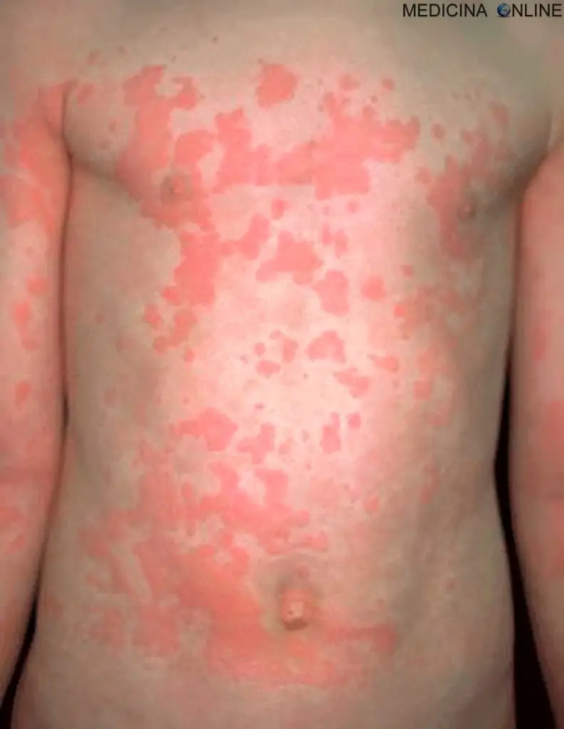 MEDICINA ONLINE ORTICARIA POMFI DERMATOSI HIVES URTICARIA