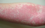 MEDICINA ONLINE ORTICARIA POMFI DERMATOSI HIVES URTICARIA