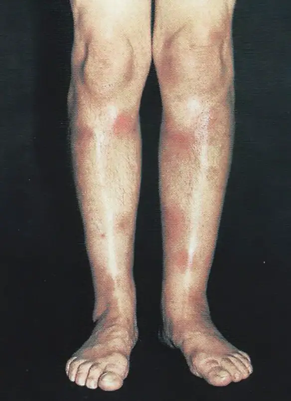 MEDICINA ONLINE PATOLOGIA CUTANEA DA FARMACI ESANTEMA ERITEMA NODOSO GAMBE.jpg