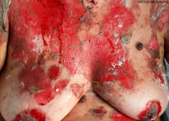 MEDICINA ONLINE PEMFIGO IMMAGINE 01