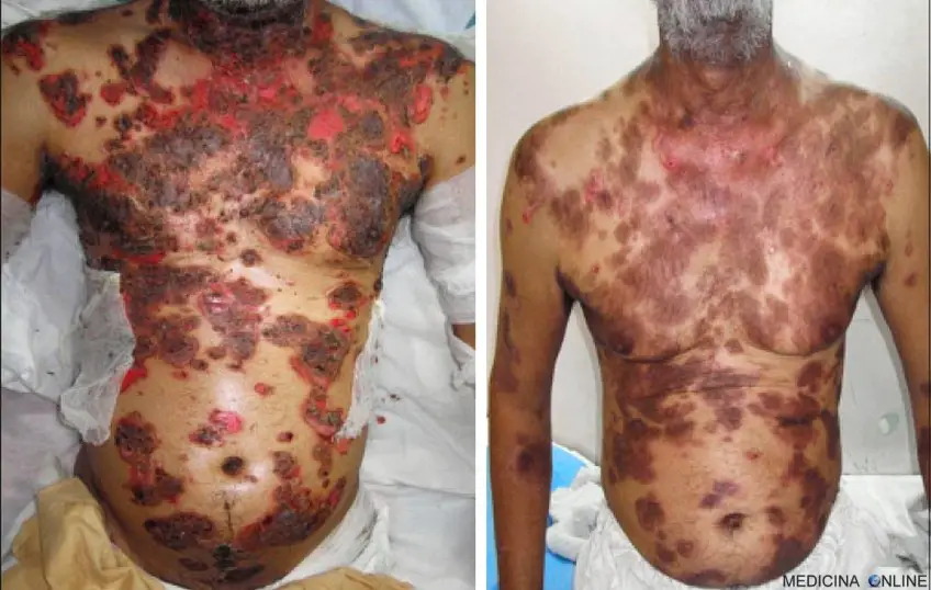 MEDICINA ONLINE PEMFIGO IMMAGINE