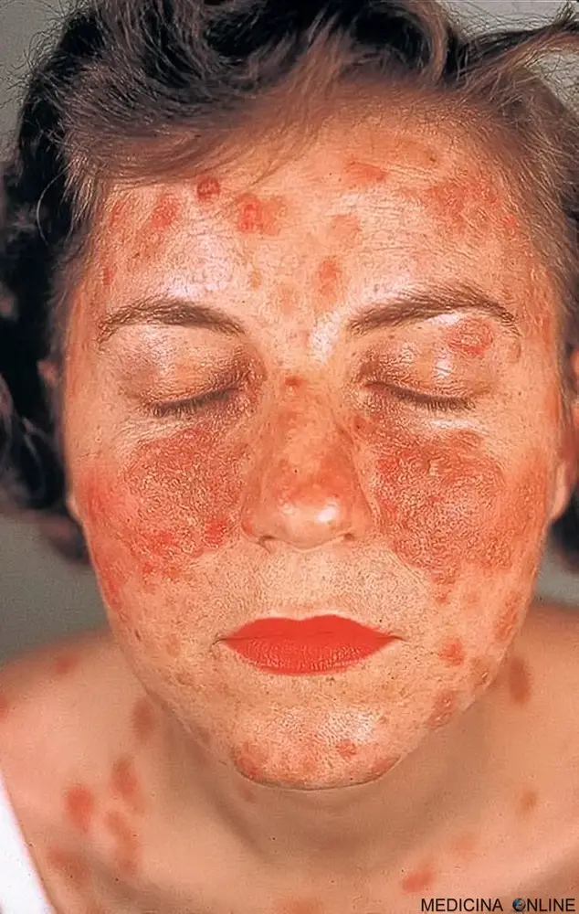 MEDICINA ONLINE PEMFIGO IMMAGINE