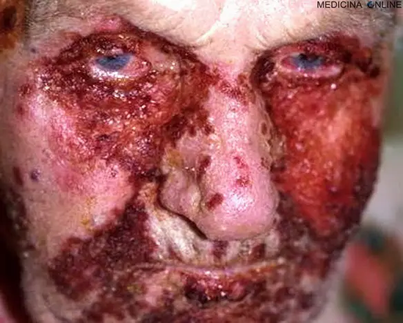 MEDICINA ONLINE PEMFIGO IMMAGINE 05.jpg