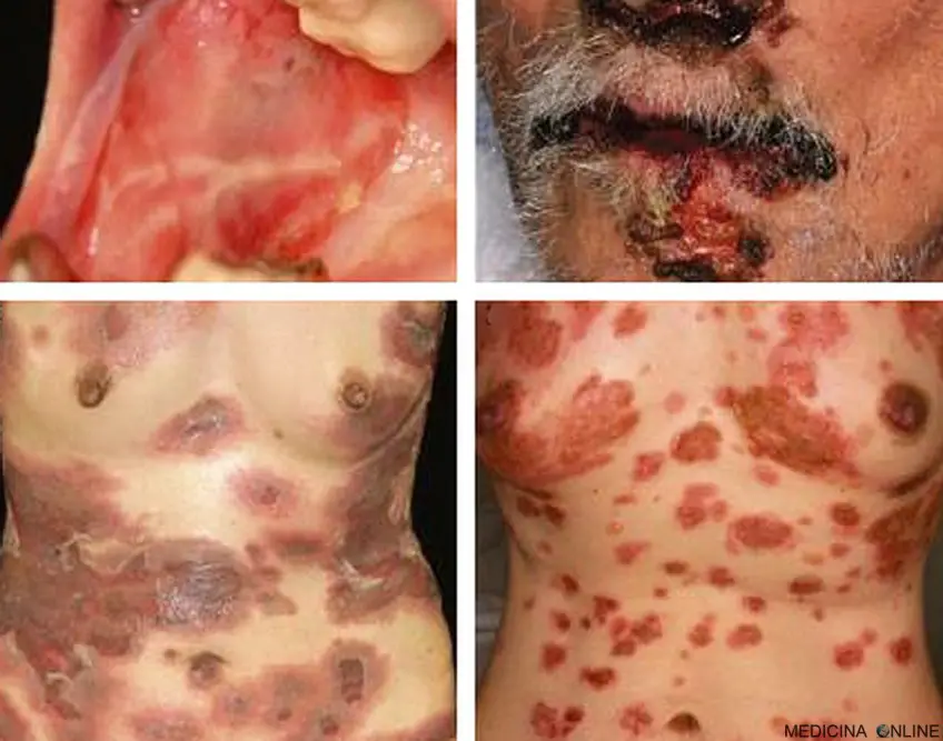 MEDICINA ONLINE PEMFIGO IMMAGINE