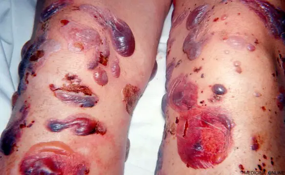 MEDICINA ONLINE PEMFIGO IMMAGINE 07