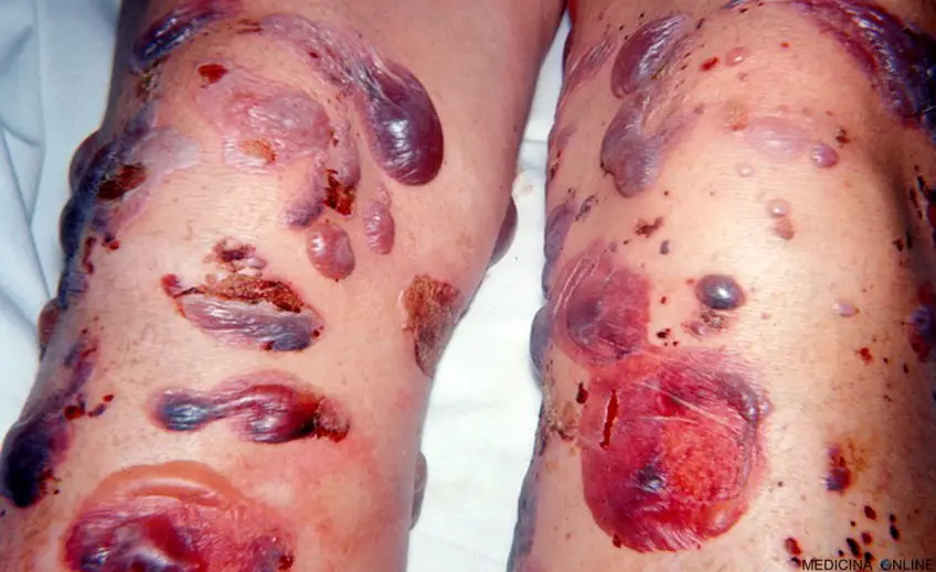 MEDICINA ONLINE PEMFIGO IMMAGINE