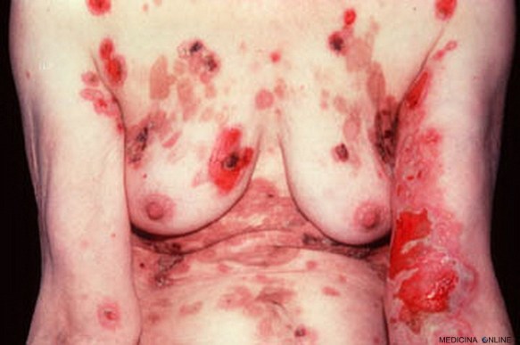 MEDICINA ONLINE PEMFIGO IMMAGINE 08