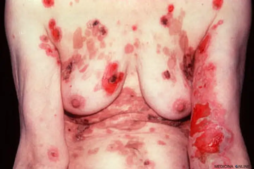 MEDICINA ONLINE PEMFIGO IMMAGINE