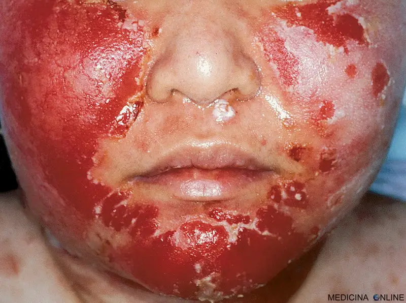 MEDICINA ONLINE PEMFIGO IMMAGINE