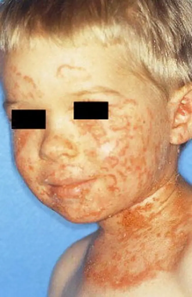 MEDICINA ONLINE PEMFIGO IMMAGINE