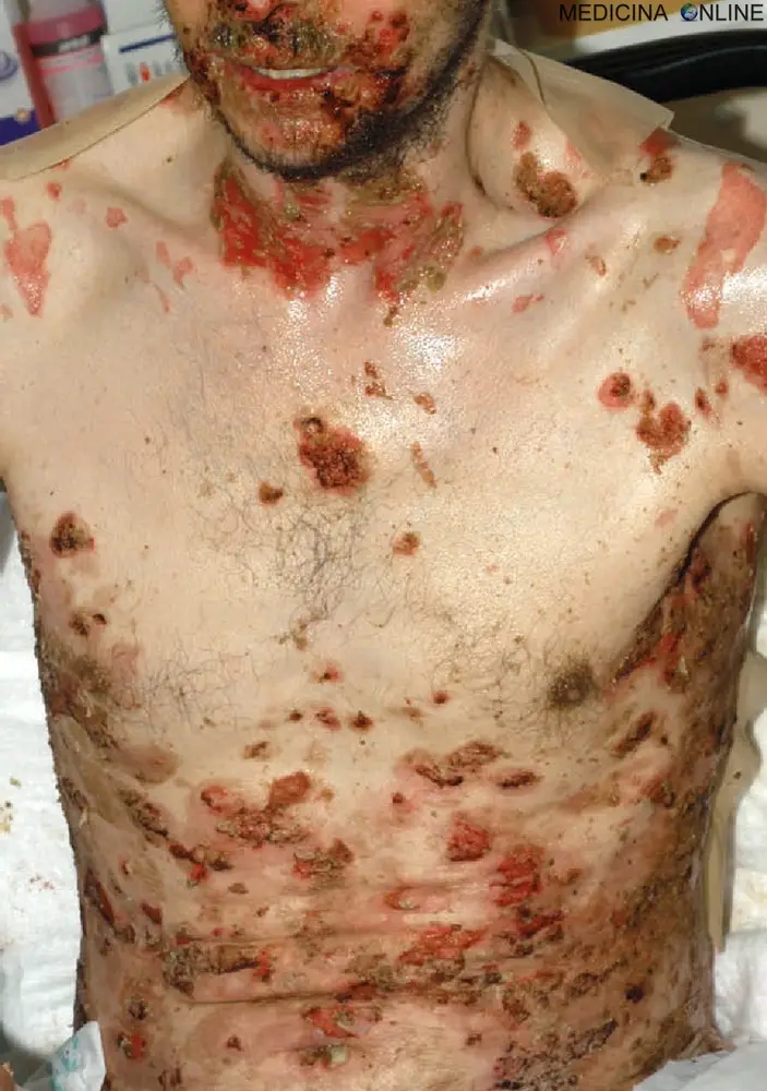 MEDICINA ONLINE PEMFIGO IMMAGINE