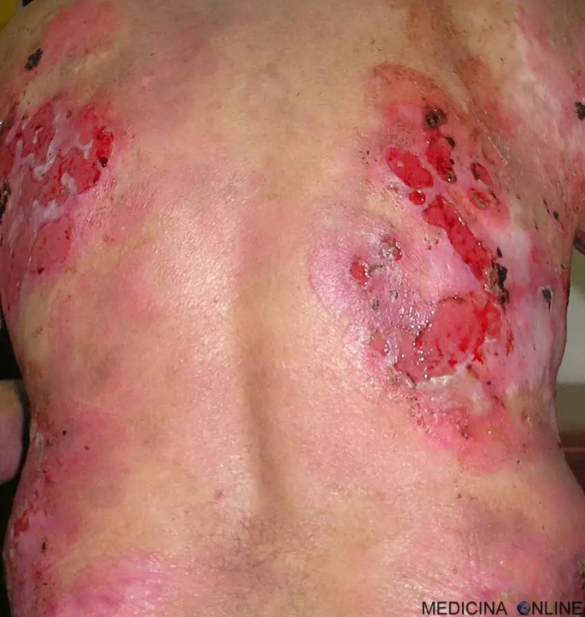 MEDICINA ONLINE PEMFIGO IMMAGINE