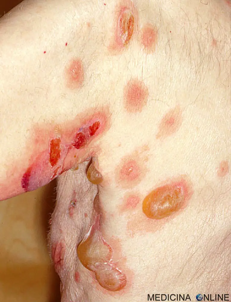 MEDICINA ONLINE PEMFIGO IMMAGINE