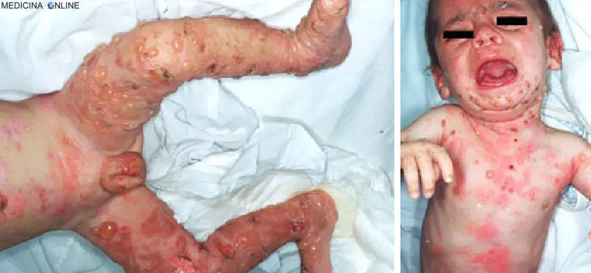 MEDICINA ONLINE PEMFIGOIDE BOLLOSO IMMAGINE