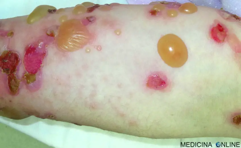 MEDICINA ONLINE PEMFIGOIDE BOLLOSO IMMAGINE