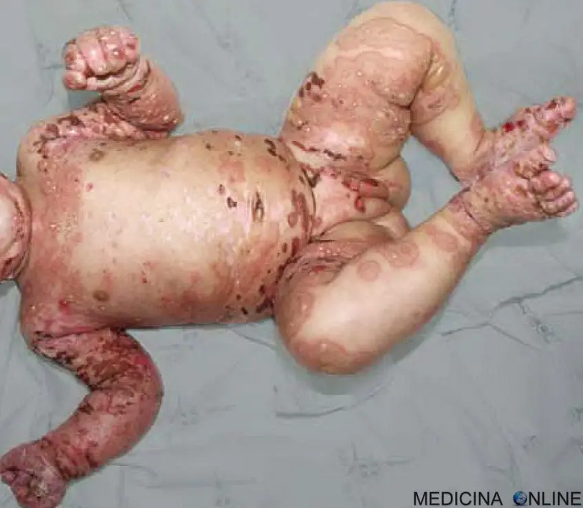 MEDICINA ONLINE PEMFIGOIDE BOLLOSO IMMAGINE