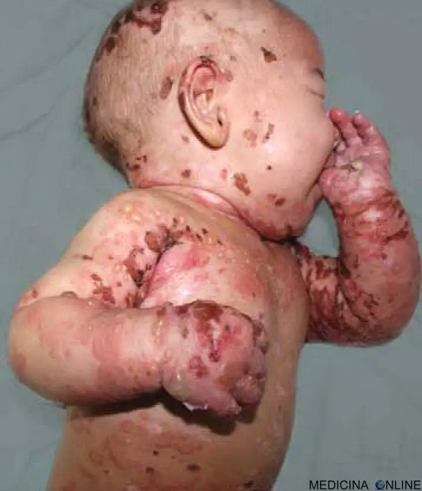 MEDICINA ONLINE PEMFIGOIDE BOLLOSO IMMAGINE