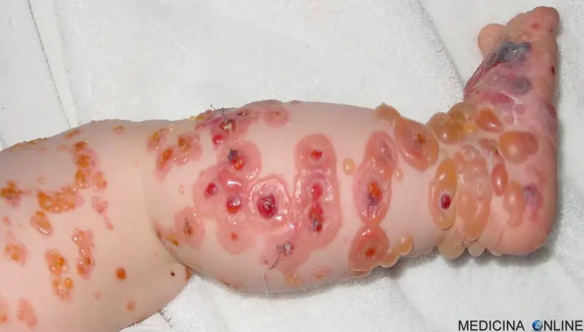 MEDICINA ONLINE PEMFIGOIDE BOLLOSO IMMAGINE