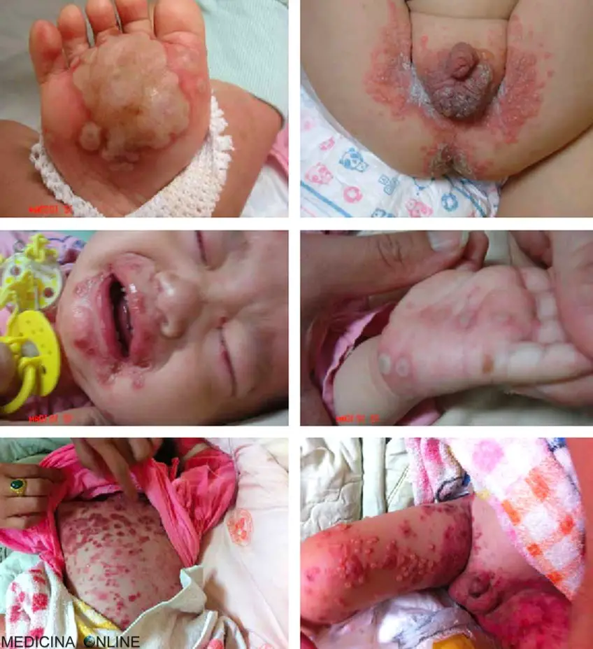MEDICINA ONLINE PEMFIGOIDE BOLLOSO IMMAGINE