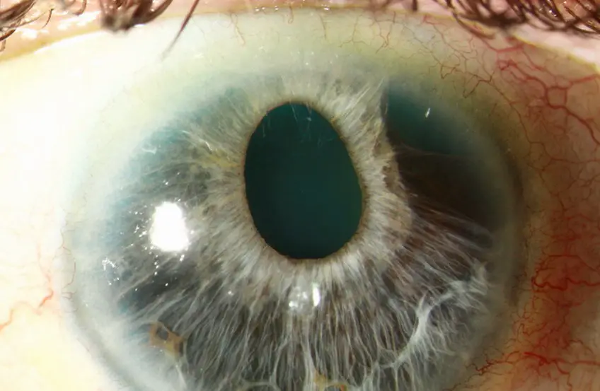 MEDICINA ONLINE OCCHIO CON SINDROME ENDOTELIALE IRIDOCORNEALE ICE SYNDROME IMMAGINE.