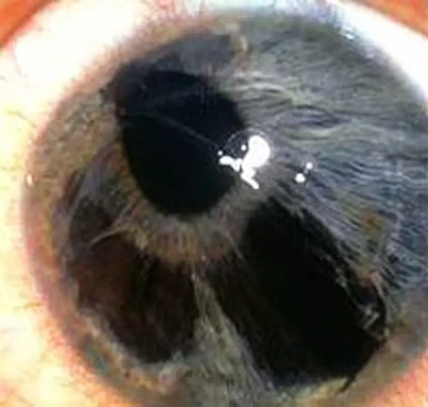 MEDICINA ONLINE OCCHIO CON SINDROME ENDOTELIALE IRIDOCORNEALE ICE SYNDROME IMMAGINE.