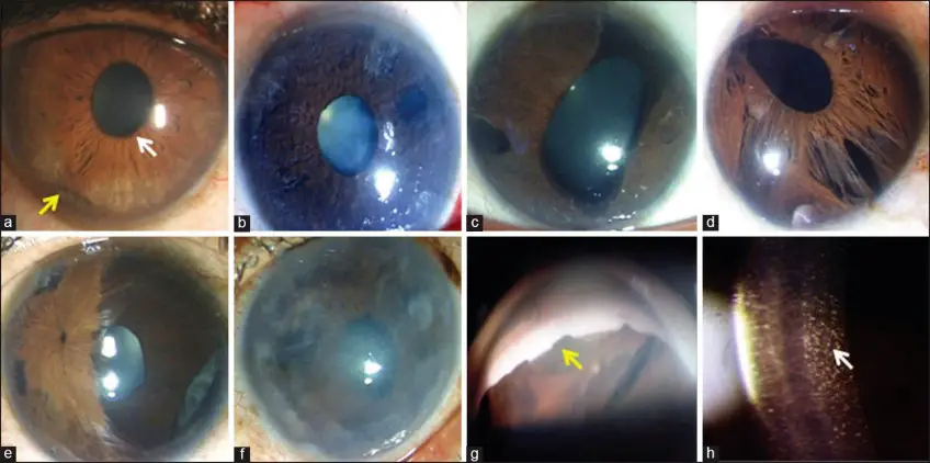 MEDICINA ONLINE OCCHIO CON SINDROME ENDOTELIALE IRIDOCORNEALE ICE SYNDROME IMMAGINE.