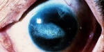 MEDICINA ONLINE OCCHIO CON SINDROME ENDOTELIALE IRIDOCORNEALE ICE SYNDROME IMMAGINE.