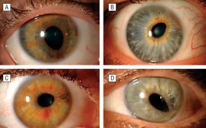 MEDICINA ONLINE OCCHIO CON SINDROME ENDOTELIALE IRIDOCORNEALE ICE SYNDROME IMMAGINE.
