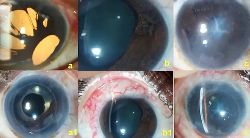 MEDICINA ONLINE OCCHIO CON SINDROME ENDOTELIALE IRIDOCORNEALE ICE SYNDROME IMMAGINE.