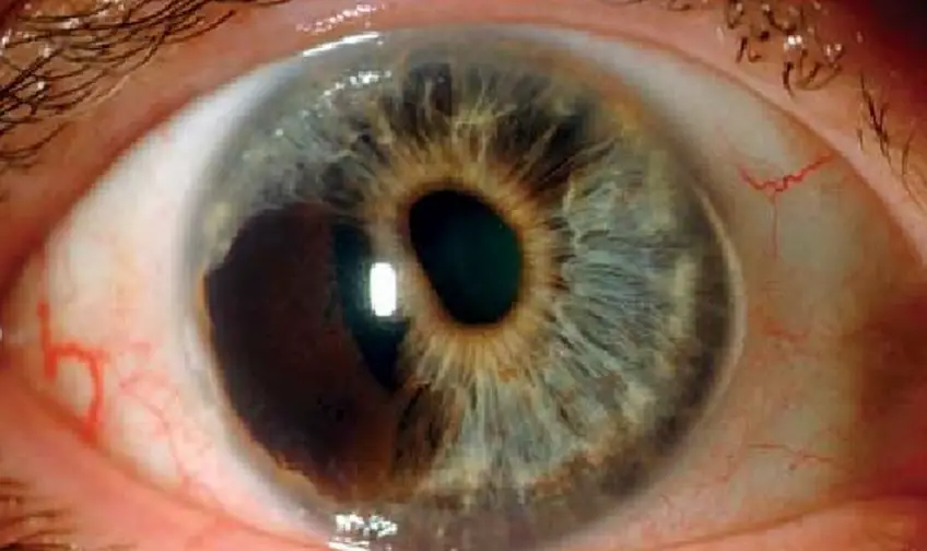 MEDICINA ONLINE OCCHIO CON SINDROME ENDOTELIALE IRIDOCORNEALE ICE SYNDROME IMMAGINE.