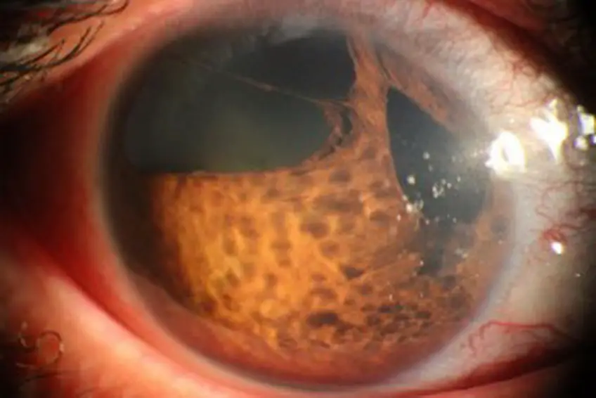 MEDICINA ONLINE OCCHIO CON SINDROME ENDOTELIALE IRIDOCORNEALE ICE SYNDROME IMMAGINE.