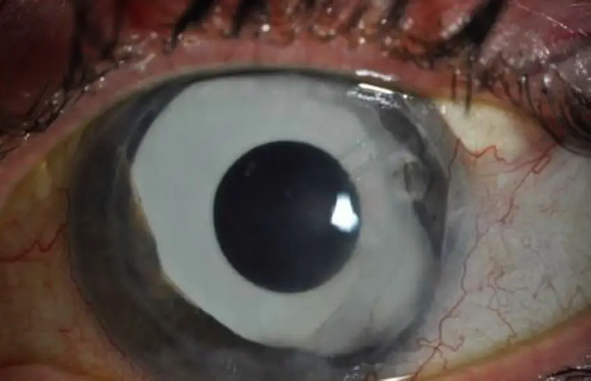 MEDICINA ONLINE OCCHIO CON SINDROME ENDOTELIALE IRIDOCORNEALE ICE SYNDROME IMMAGINE.