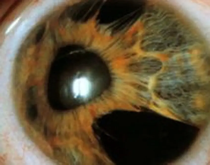 MEDICINA ONLINE OCCHIO CON SINDROME ENDOTELIALE IRIDOCORNEALE ICE SYNDROME IMMAGINE.