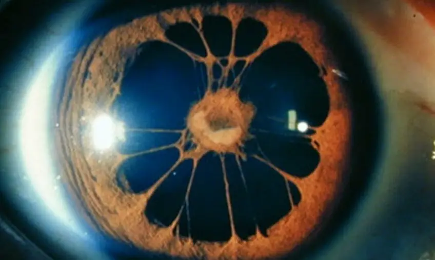 MEDICINA ONLINE OCCHIO CON SINDROME ENDOTELIALE IRIDOCORNEALE ICE SYNDROME IMMAGINE.