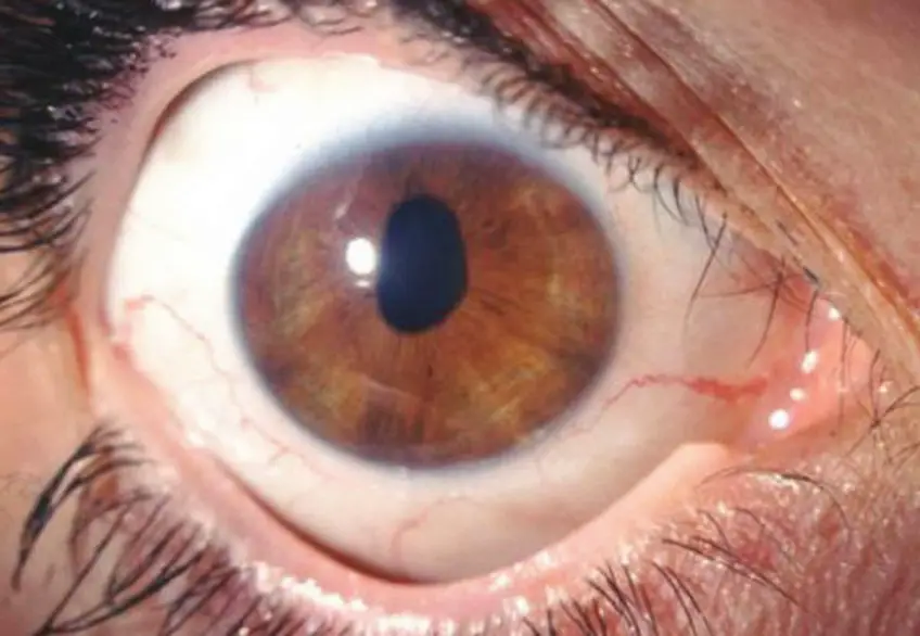 MEDICINA ONLINE OCCHIO CON SINDROME ENDOTELIALE IRIDOCORNEALE ICE SYNDROME IMMAGINE.