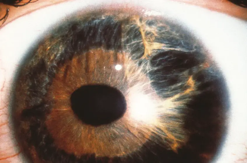 MEDICINA ONLINE OCCHIO CON SINDROME ENDOTELIALE IRIDOCORNEALE ICE SYNDROME IMMAGINE.