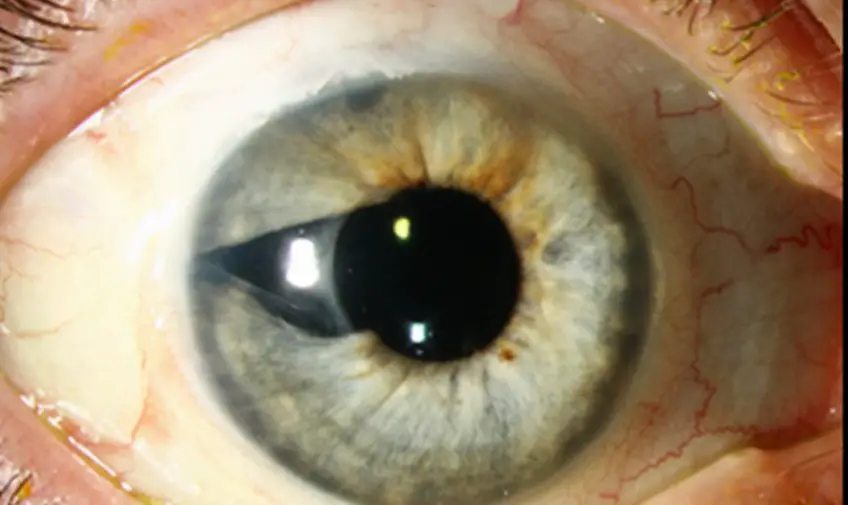 MEDICINA ONLINE OCCHIO CON SINDROME ENDOTELIALE IRIDOCORNEALE ICE SYNDROME IMMAGINE.