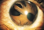 MEDICINA ONLINE OCCHIO CON SINDROME ENDOTELIALE IRIDOCORNEALE ICE SYNDROME IMMAGINE.
