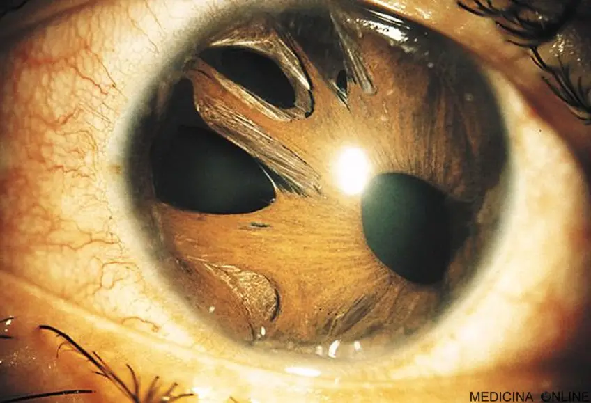 MEDICINA ONLINE OCCHIO CON SINDROME ENDOTELIALE IRIDOCORNEALE ICE SYNDROME IMMAGINE.