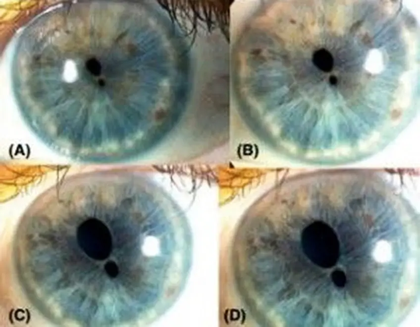 MEDICINA ONLINE POLICORIA OCCHIO CON PIU PUPILLE IN IRIDE IMMAGINE.