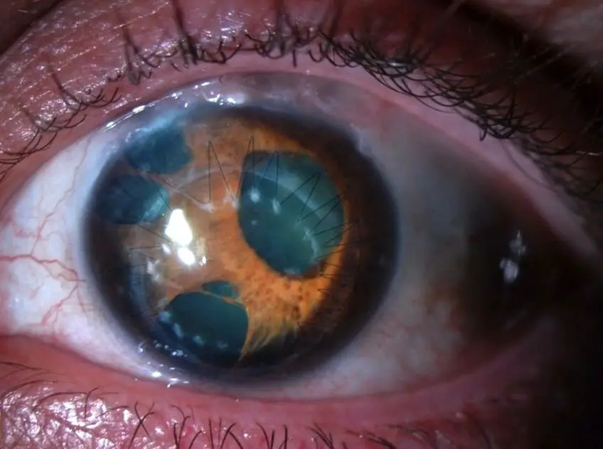 MEDICINA ONLINE POLICORIA OCCHIO CON PIU PUPILLE IN IRIDE IMMAGINE.